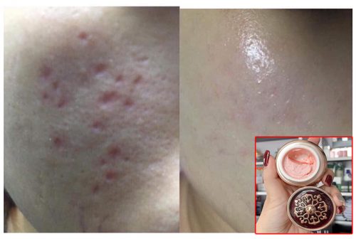 Công dụng của kem trị seo genie non fix skin: